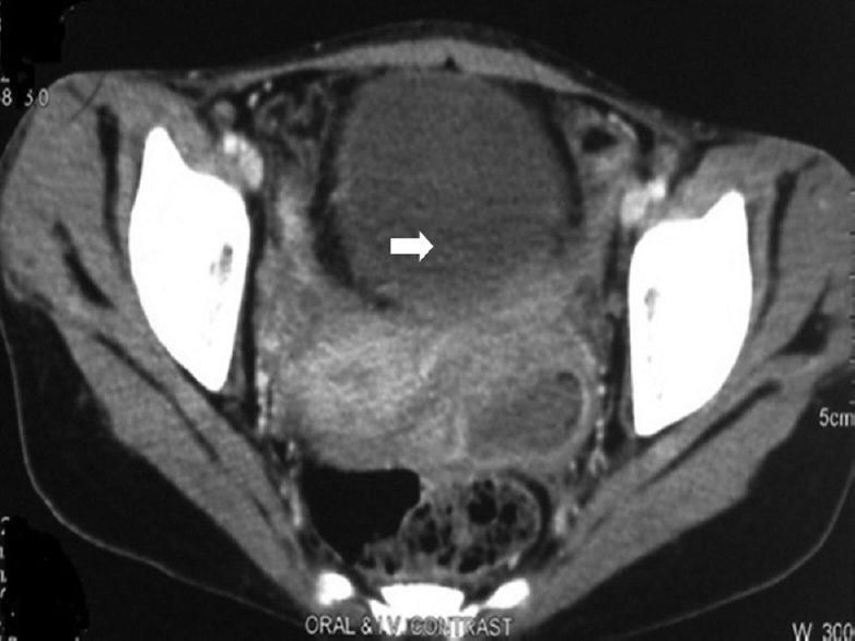 Computed tomography with unilateral tubo-ovarianmass in female genital tuberculosis.